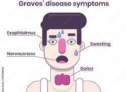 When the Thyroid Works Too Fast A Simple Guide to Graves Disease